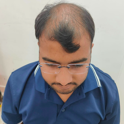 Before Hair Transplant - Our Real patient from Udaipur, Rajasthan