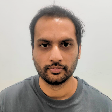 Before Hair Transplant - Our Real patient from Udaipur