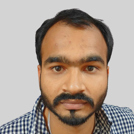 Before Hair Transplant - Our Real patient from Udaipur